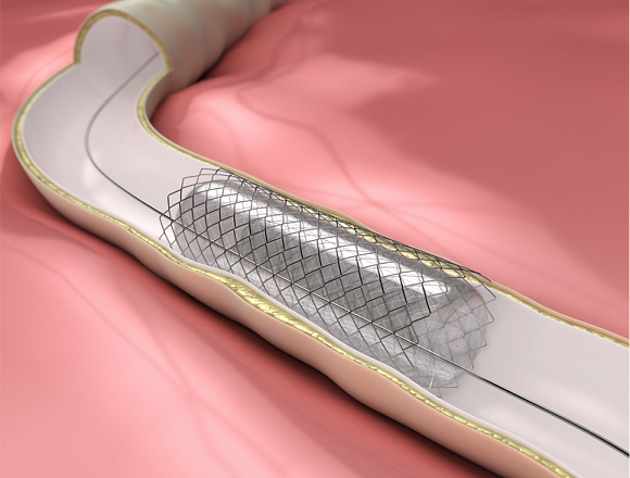 Peripheral Angioplasty